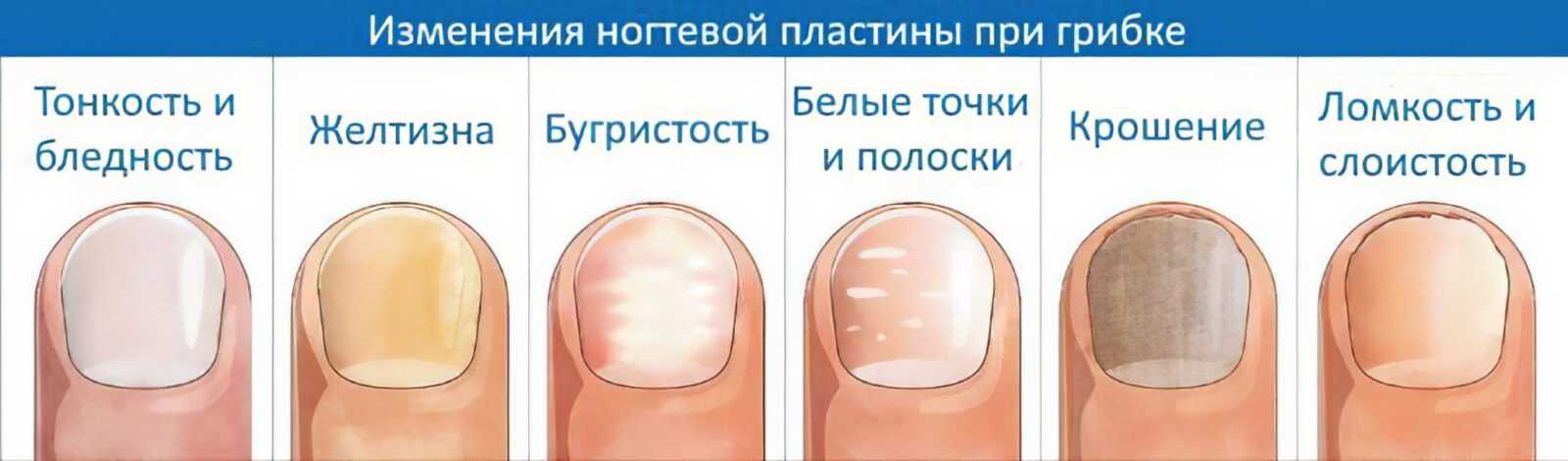 Деформация ногтей - причины, диагностика и лечение