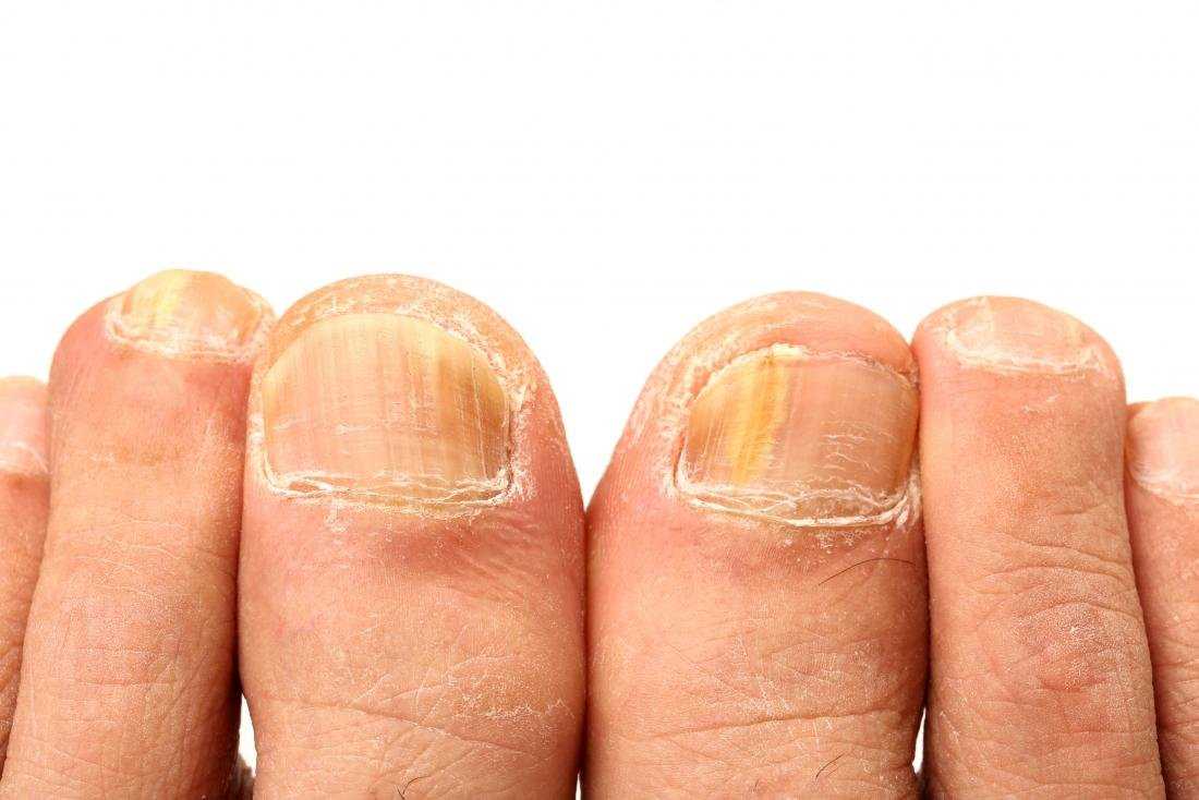 Трещины на ногтях: причины, виды и лечение
