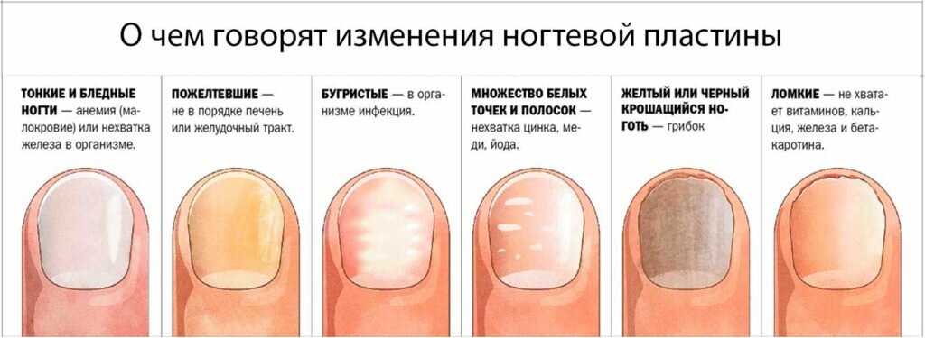 Болезни ногтей: как определить заболевание