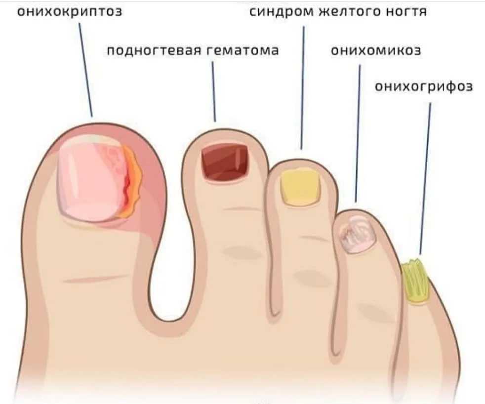 Как вылечить грибок на ногтях ног